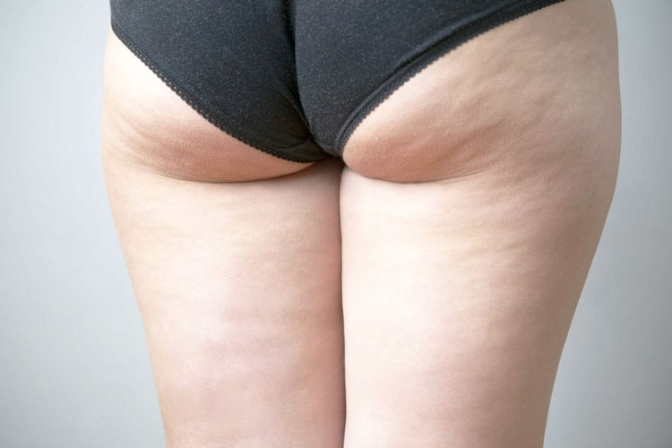How Can I Get Rid of Cellulite on Fast?